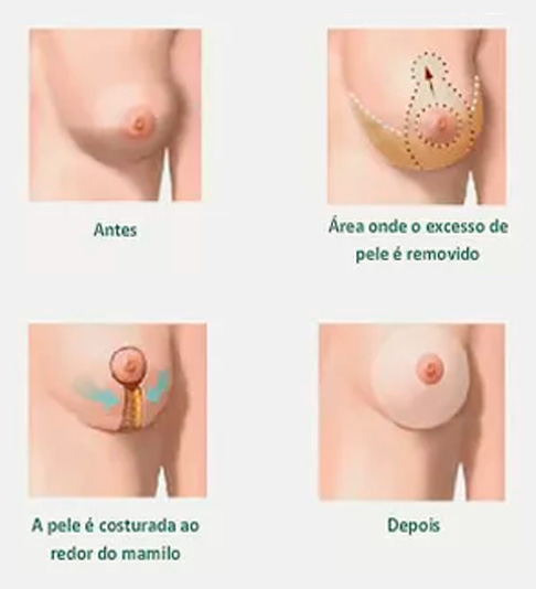 ANTES DO SILICONE