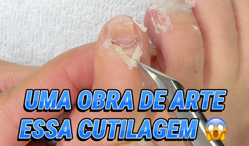 Cutilagem do Mindinho do Pé em 2025: Transformação Passo a Passo e Dicas
