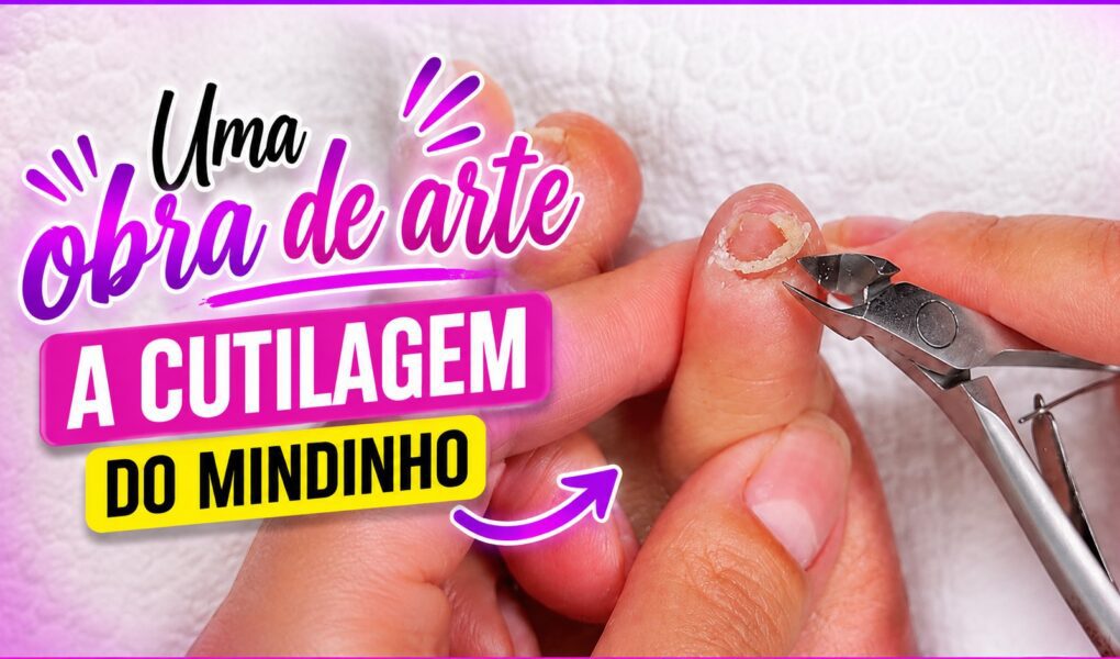 Cutilagem do dedo mindinho com Stalex Smart 31