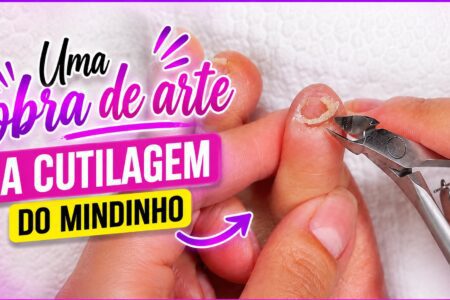 Cutilagem do dedo mindinho com Stalex Smart 31